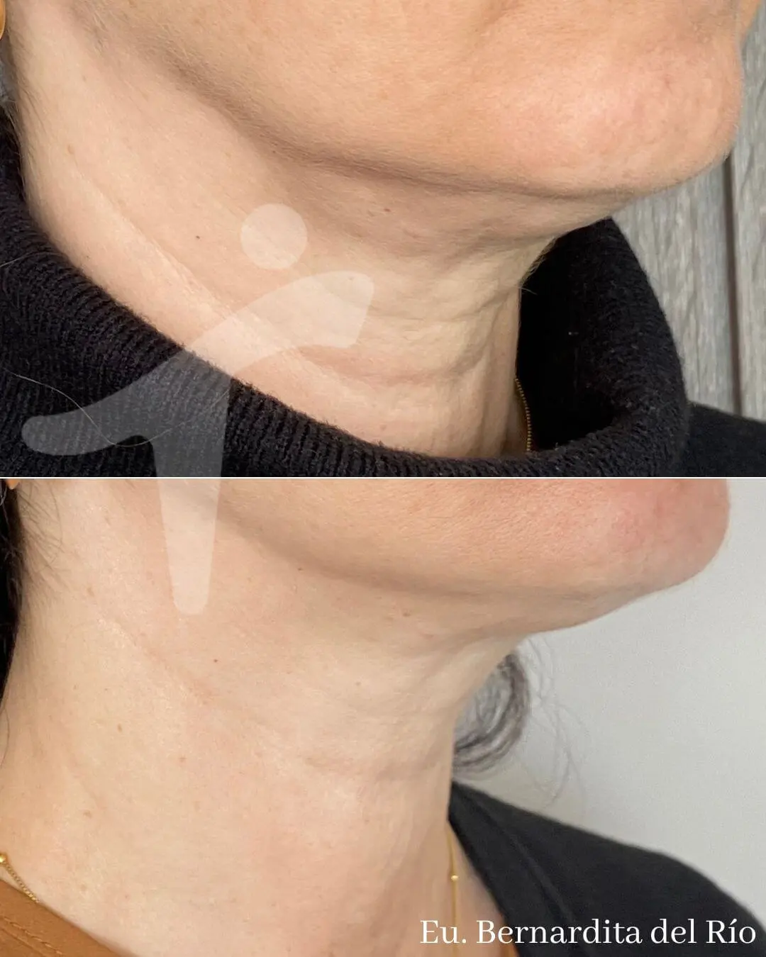 Bioestimuladores de Colágeno Faciales