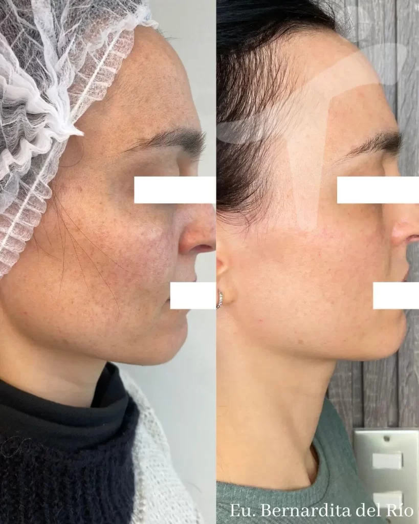 Peeling Químico Facial