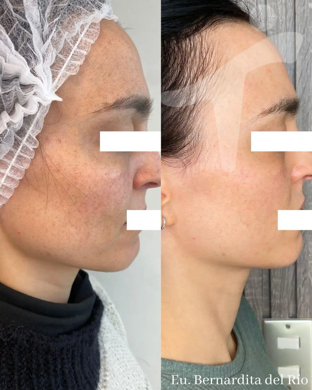 Peeling Químico Facial