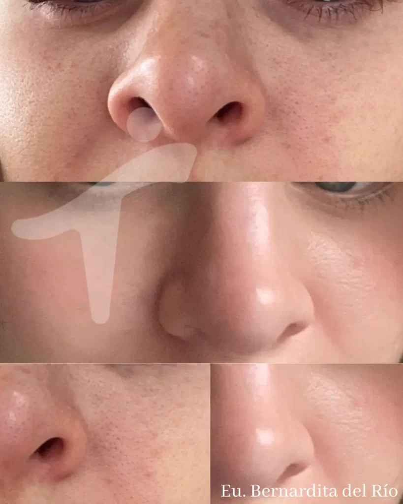 Peeling Químico Facial
