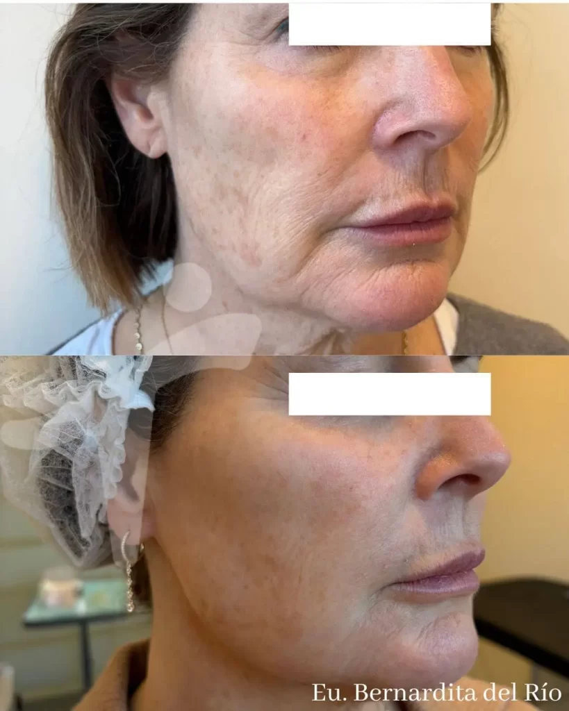 Bioestimuladores de Colágeno Faciales