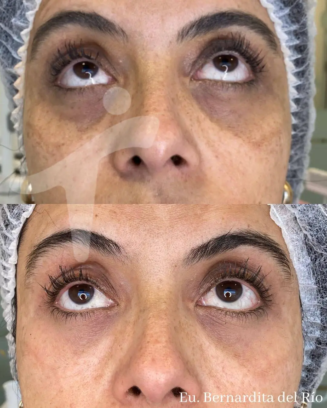 Peeling Químico Facial