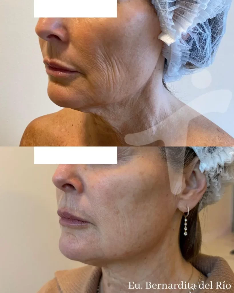 Bioestimuladores de Colágeno Faciales