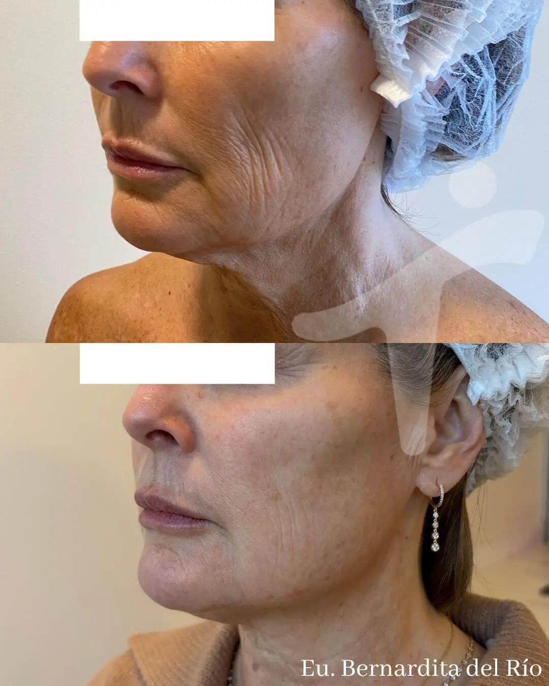 Bioestimuladores de Colágeno Faciales