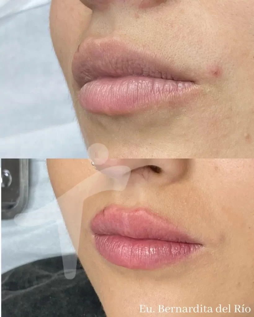 Micropigmentación de labios