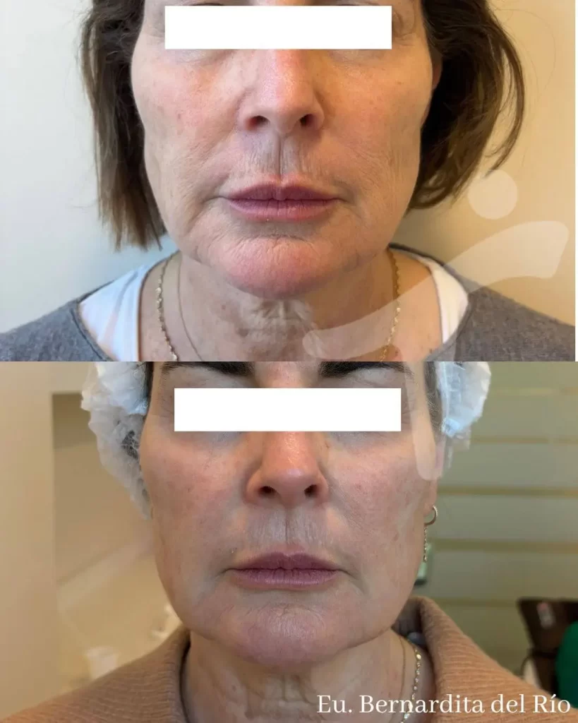 Bioestimuladores de Colágeno Faciales