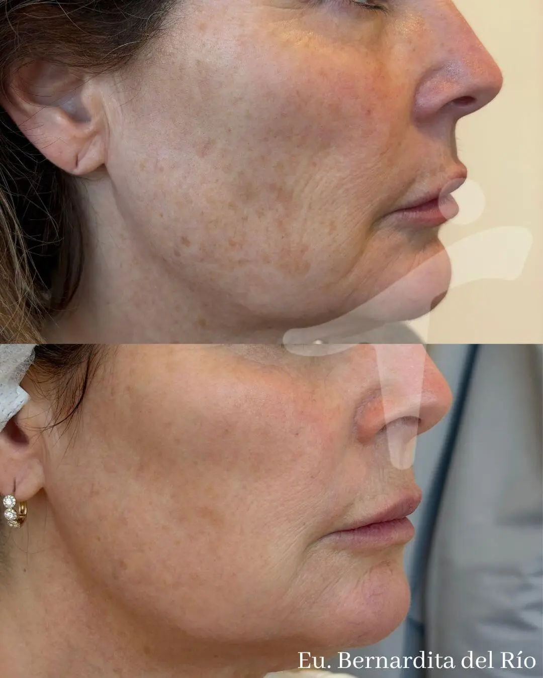 Peeling Químico Facial