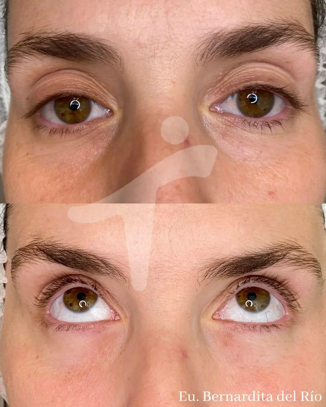 Bioestimuladores de Colágeno Faciales