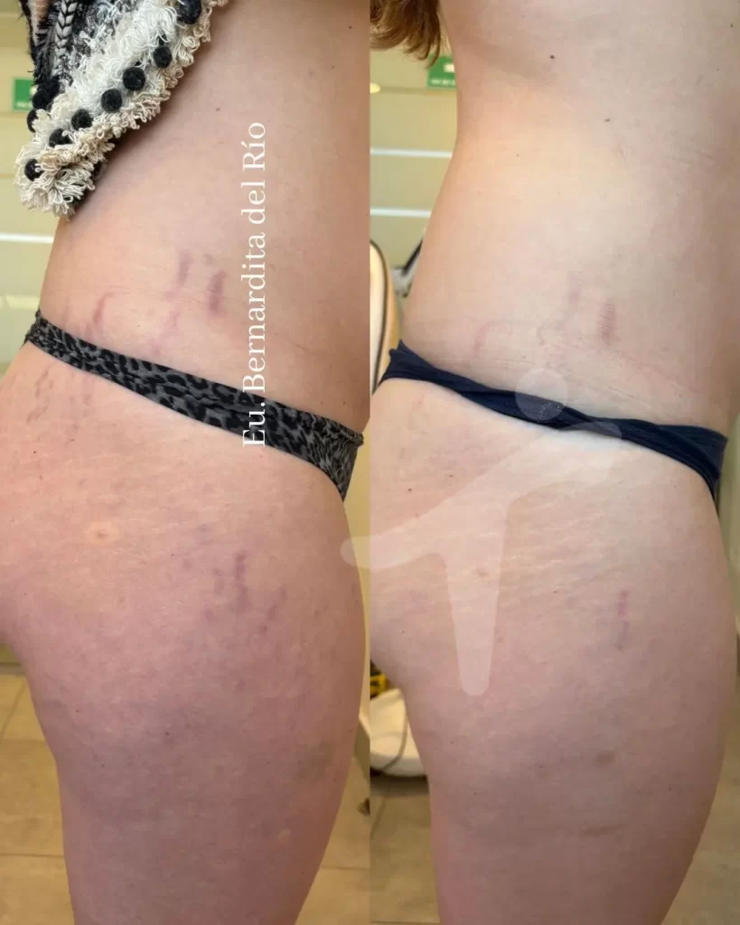 Eliminación de Estrías