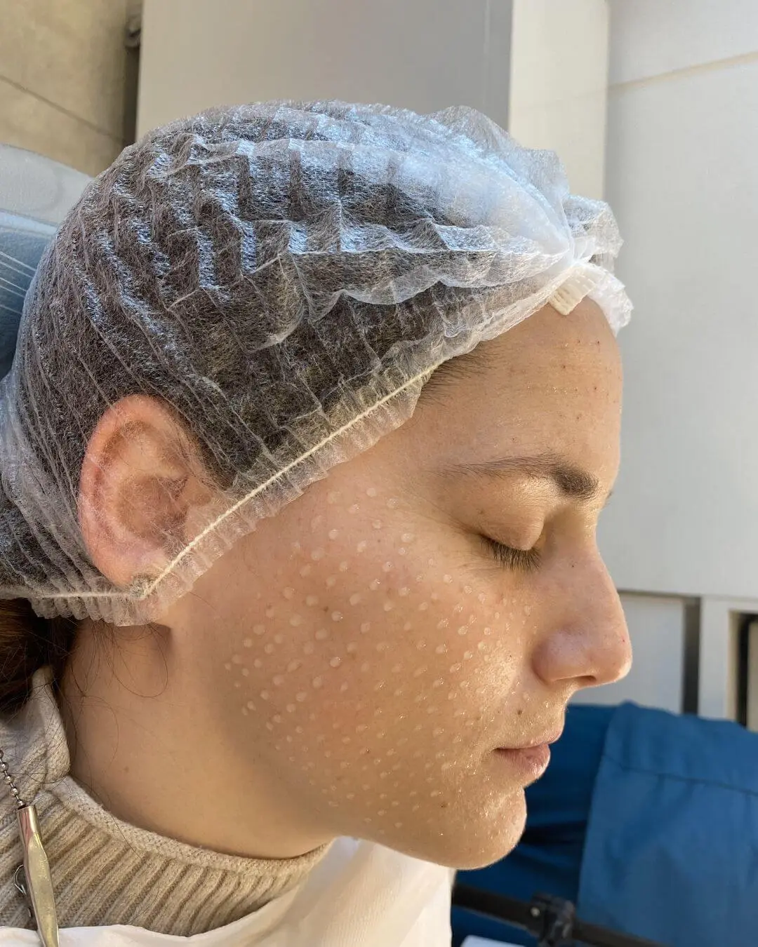 Microneedling con Vitaminas