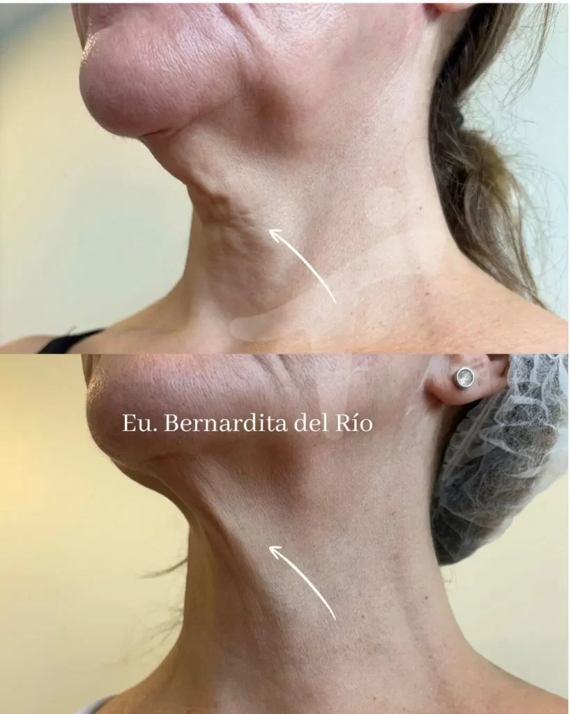 Láser Co2 Fraccionado Facial