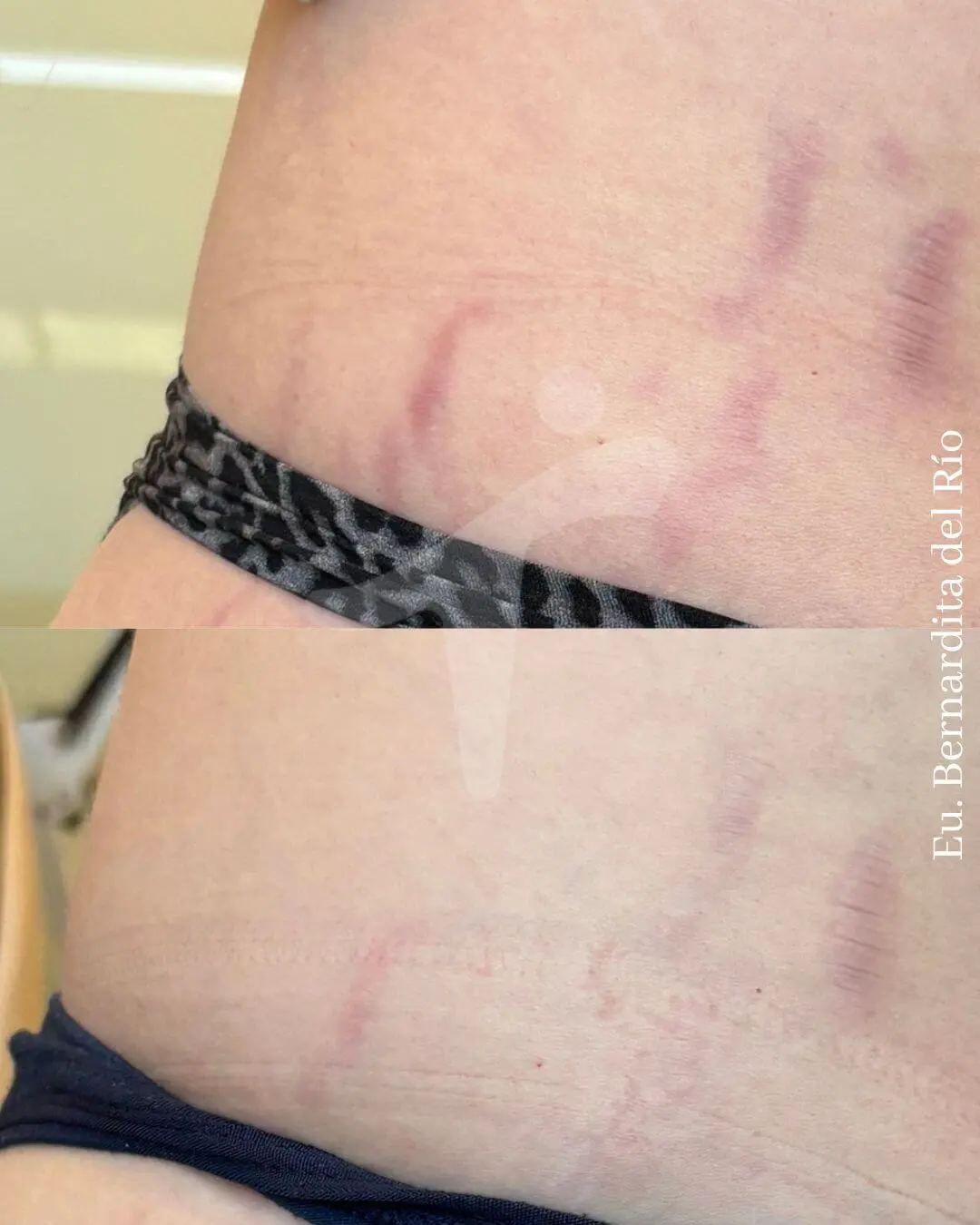 Eliminación de Estrías