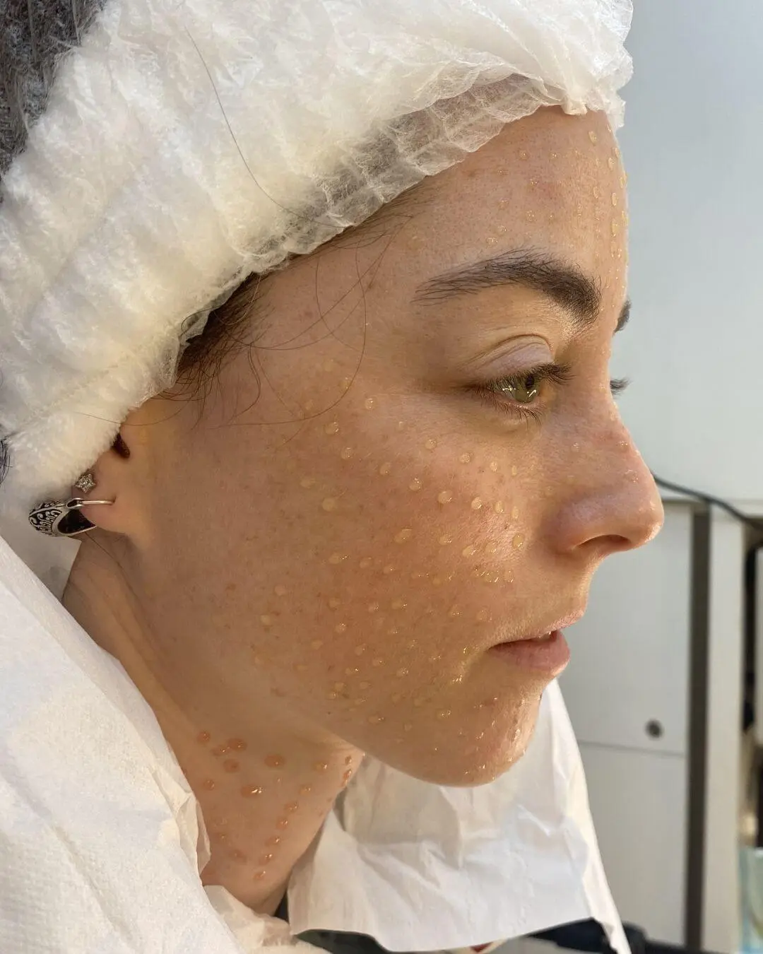 Microneedling con Vitaminas
