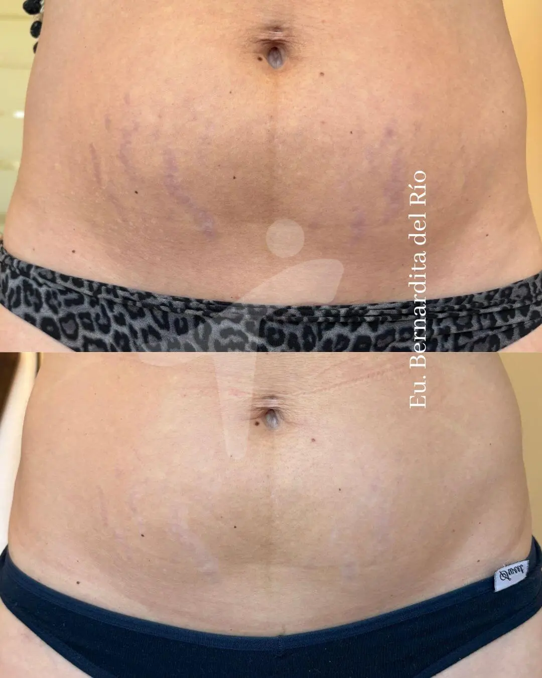 Eliminación de Estrías