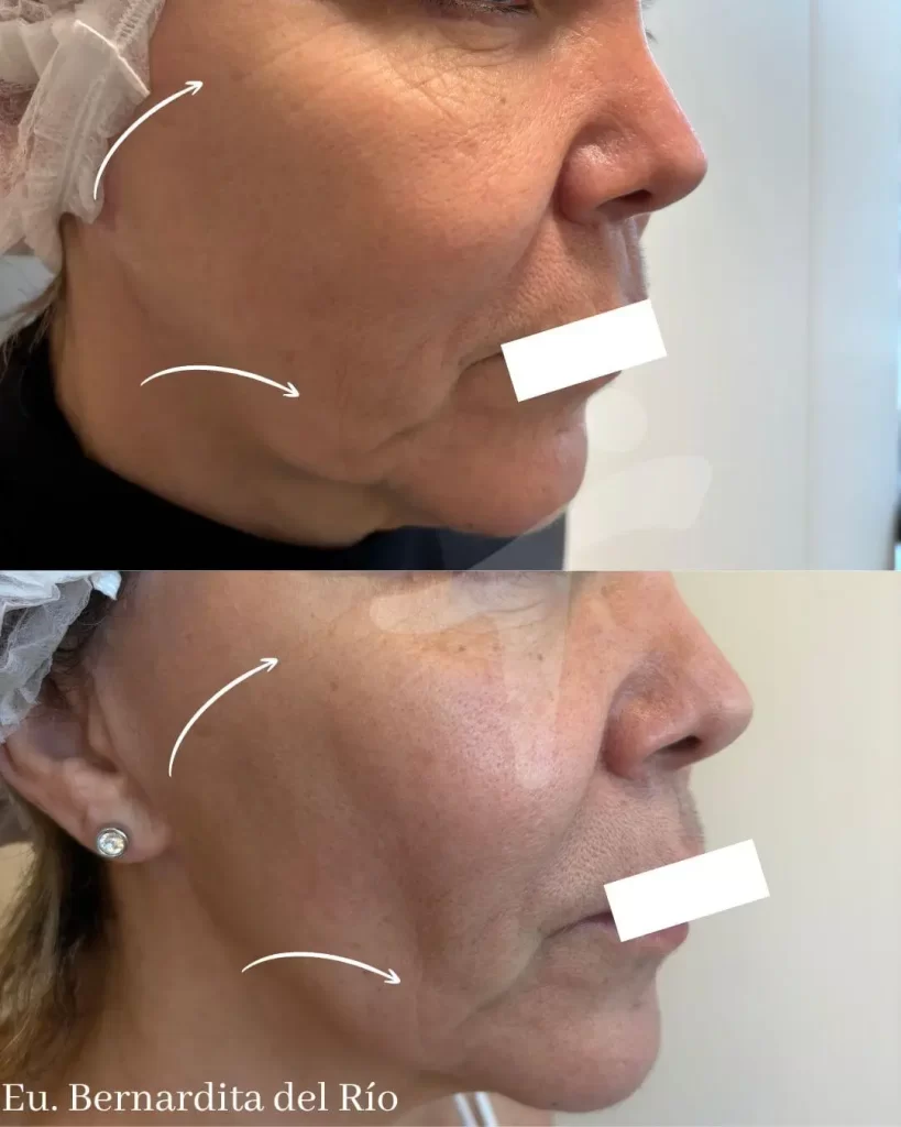Láser Co2 Fraccionado Facial