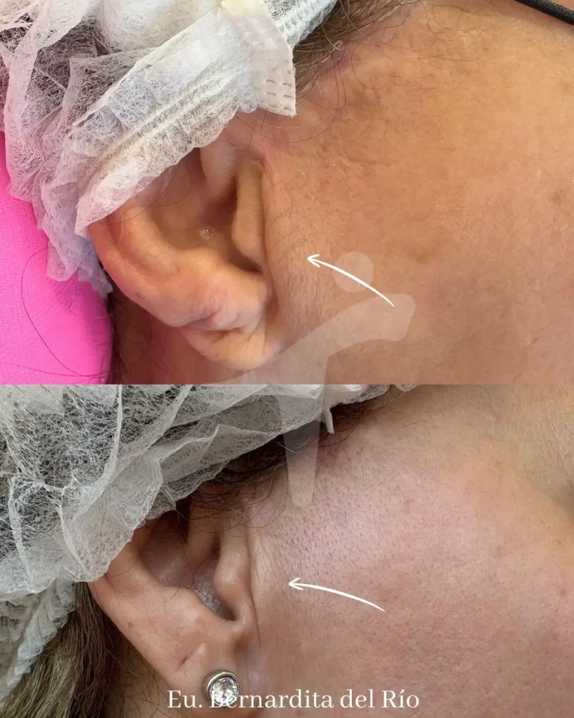 Láser Co2 Fraccionado Facial