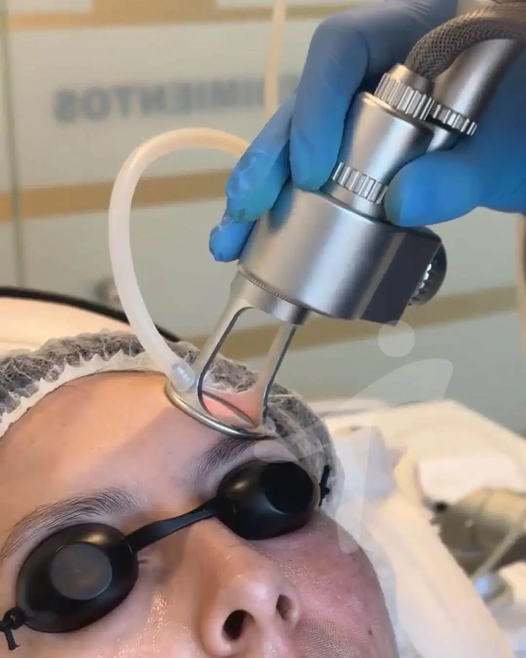 Láser Co2 Fraccionado